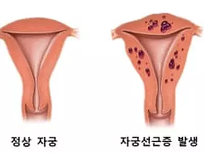 난임여성 10명중 1명 갑상선·부인과 질환