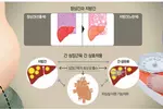 당뇨병 부르는 비알코올 지방간…‘3高 식단〈고탄수화물·고지방·고당분〉’ 피해라