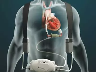 1년 생존율 20% 말기 심부전‘인공심장 이식’새 삶