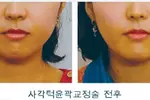 갸름한 턱 만들려 보톡스 즐겨하다간… ‘보툴리눔 내성’생길라
