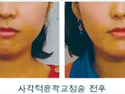 갸름한 턱 만들려 보톡스 즐겨하다간… ‘보툴리눔 내성’생길라
