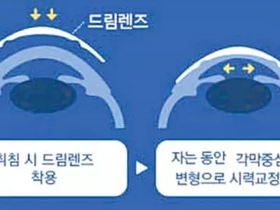 “만1세-사시, 3세-약시, 6세-안경필요성 검사를”