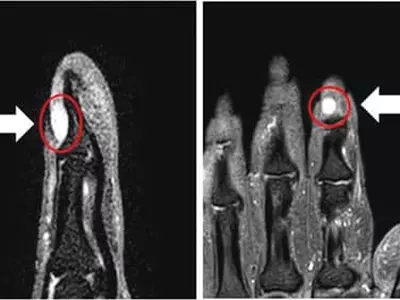 찬물에 손끝 닿기만 해도 극심한 통증? 혹시 ‘사구체 종양’