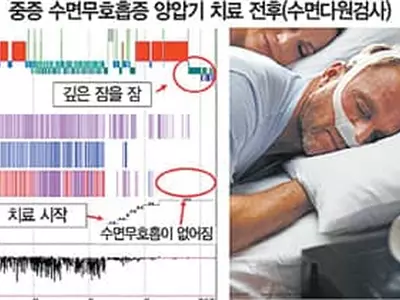 “불편해도 기도양압기‘코 마스크’ 쓰고 주무세요”