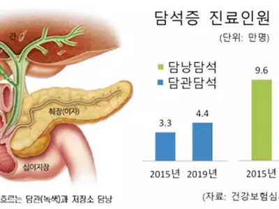 자주 체하고 명치부위 복통… 위에 이상 없으면 담석 때문?