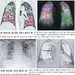 AI로 분석… 코로나환자 폐렴 중증도 판별 쉬워진다