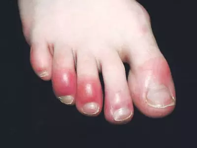 ‘발가락 붉은 발진’ 신종증세 확산