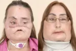 미국 첫 얼굴 전체 이식 여성 12년만에 사망