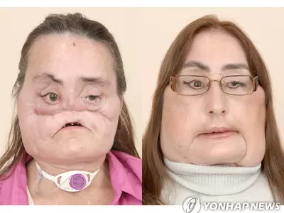 미국 첫 얼굴 전체 이식 여성 12년만에 사망