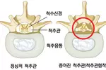 조금만 걸어도‘찌릿찌릿’척추관협착증 의심해야