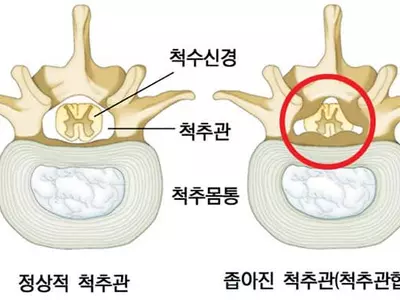 조금만 걸어도‘찌릿찌릿’척추관협착증 의심해야