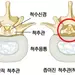 조금만 걸어도‘찌릿찌릿’척추관협착증 의심해야