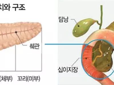 황달·명치 통증 지속땐 췌장암 정밀진단을