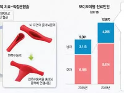 뇌혈관 좁아져 뇌졸중 초래…모야모야병, 어릴수록 진행 빨라