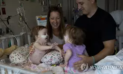 몸통 붙은 채 태어난 14개월 샴쌍둥이 분리 성공