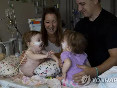 몸통 붙은 채 태어난 14개월 샴쌍둥이 분리 성공