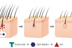 ‘대머리형 탈모’샴푸·약용효과 미미