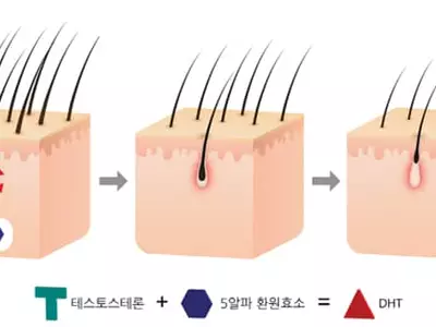 ‘대머리형 탈모’샴푸·약용효과 미미