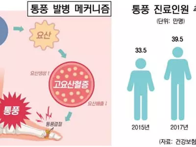 발가락 통증엔 소염제? 만성 통풍으로 키울라