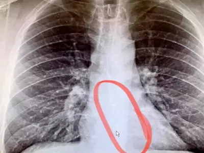 음악 들으며 잠자다 이어폰 삼킨 남성