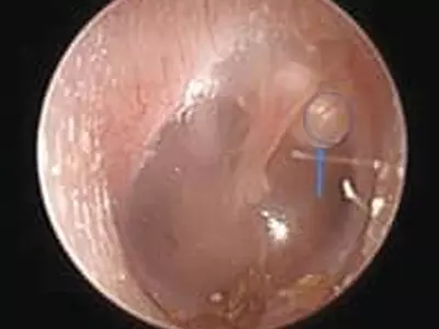 귓속에 진주 모양의 종양이?… 방치하면 난청