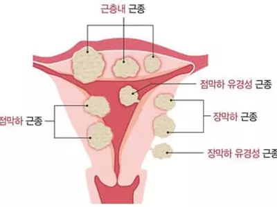잘 모르는 자궁근종 궁금증 4가지