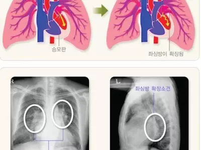 승모판막 폐쇄부전증,‘클립 이용한 시술’효과