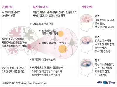 FDA 전 자문위원 "알츠하이머 신약 효과 증거없어"