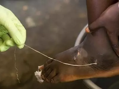 '카터의 꿈' 기생충 기니벌레 퇴치 최근접…전세계 발병 단 14건