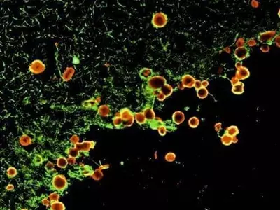 루게릭병과 전측두엽 치매, 모두 관여하는 돌연변이 발견