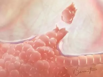 뼈냐 아니면 폐냐? 유방암은 어떻게 전이 방향 결정할까