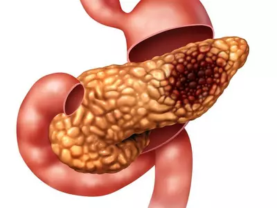 췌장암, 최근 13년새 2.15배 증가