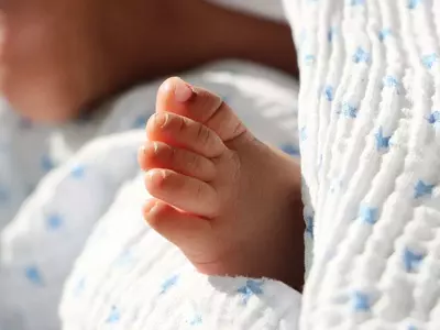 어린이 급성 간염 급증 25개주 확산, 5명 사망