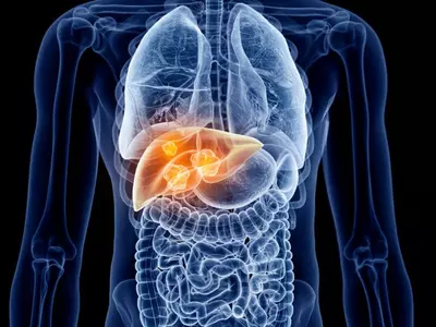 “간암 재발해도 복강경 수술 적극 고려해 볼 만하다”