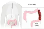 대장암 유발하는‘궤양성 대장염’10년 새 4.8배