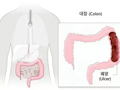 대장암 유발하는‘궤양성 대장염’10년 새 4.8배