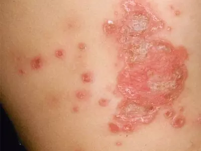 혹시‘원숭이두창’?… ‘수두’‘대상포진’‘농가진’과 유사