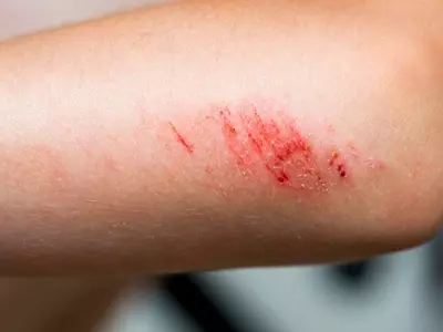 고혈압이라면 흉터를 악화시키기 쉬워