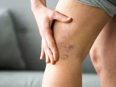 다리 혈관 튀어나온 하지정맥류, 족욕ㆍ반신욕은 역효과