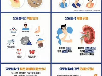 출산통 같은 옆구리 고통이…여름철 복병‘요로결석’