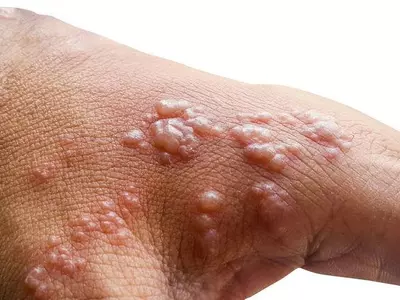 조지아 원숭이두창 확진자 48명