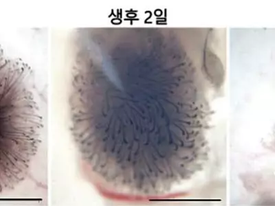 ‘모낭 세포’소멸 원인 규명… 탈모 예방 길 열었다