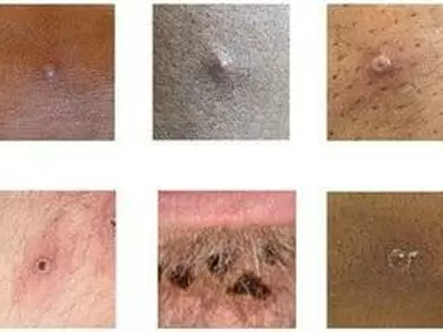 WHO, 원숭이 두창에 국제적 보건 비상사태 선언