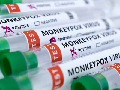 미국내 원숭이두창 감염자 1만8천400명 중 어린이 31명