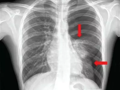 10대 청소년에게 발생하는 가슴 통증과 호흡곤란