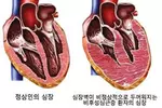 심장 벽 두꺼워지는‘비후성 심근증’, 정신 질환 위험도 높여