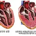 심장 벽 두꺼워지는‘비후성 심근증’, 정신 질환 위험도 높여