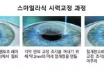 스마일 라식, 기존 라식보다 수술 정확성·시력 질 뛰어나