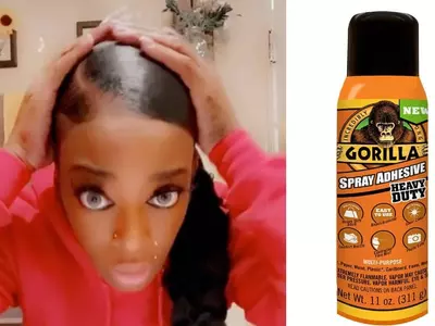 머리손질에 강력접착제 쓴 여성 수술 받고 회복