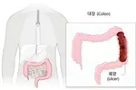 “암 사망자 10%가 대장암”… 내시경검사로 조기 발견